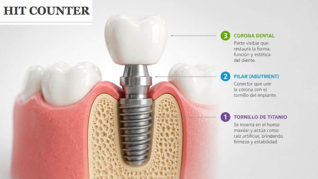 Ilustración 3D de un implante dental con tornillo, pilar y corona